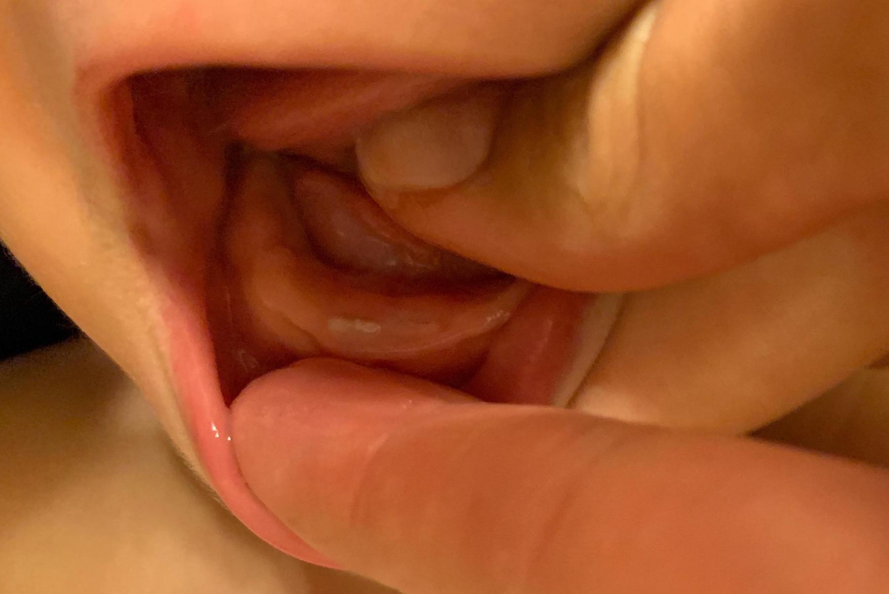 lower front teeth erupting on baby