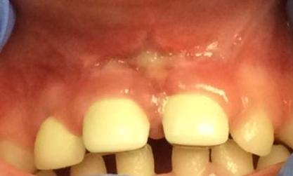 Large-cavities-on-front-teeth-fixed-with-white-faced-crowns-After-Image