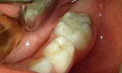 SDF-on-Baby-Molar-After-Image