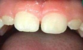 Trauma-to-adult-front-tooth-After-Image