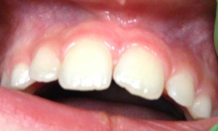 Upper-Lip-Frenectomy-with-Erupting-Adult-Dentition-After-Image