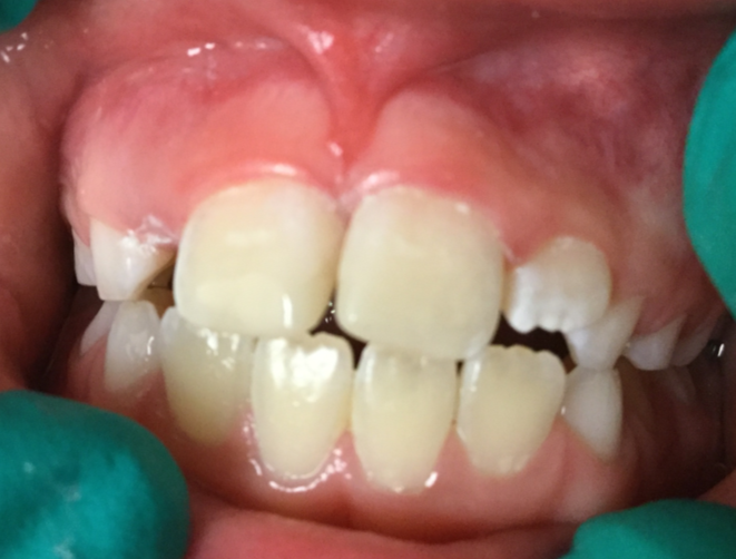 8-year-old-trauma-to-front-teeth-After-Image