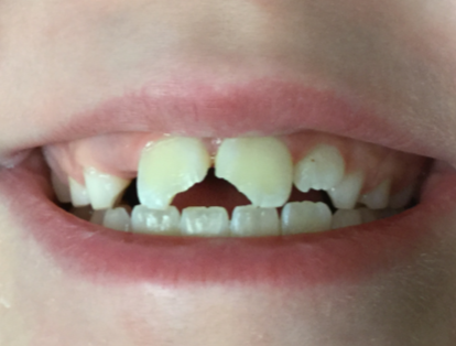 8-year-old-trauma-to-front-teeth-Before-Image