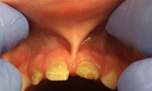 Large-cavities-on-front-teeth-fixed-with-white-faced-crowns-Before-Image