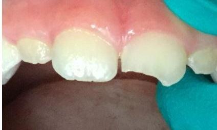 Trauma-to-adult-front-tooth-Before-Image